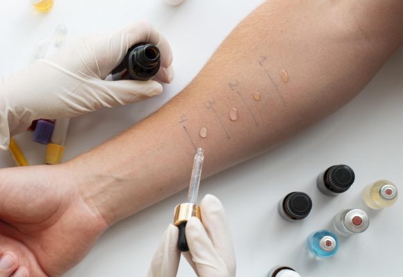 แพ้อะไร.. ป้องกันได้ด้วย ‘SKIN TEST’