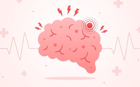 Stroke โรคหลอดเลือดสมอง รู้ทัน ป้องกันได้🩺🧠