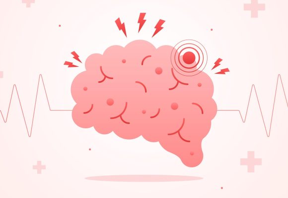 Stroke โรคหลอดเลือดสมอง รู้ทัน ป้องกันได้🩺🧠